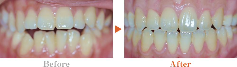 すきっ歯（正中離開、空隙歯列）の特徴と原因