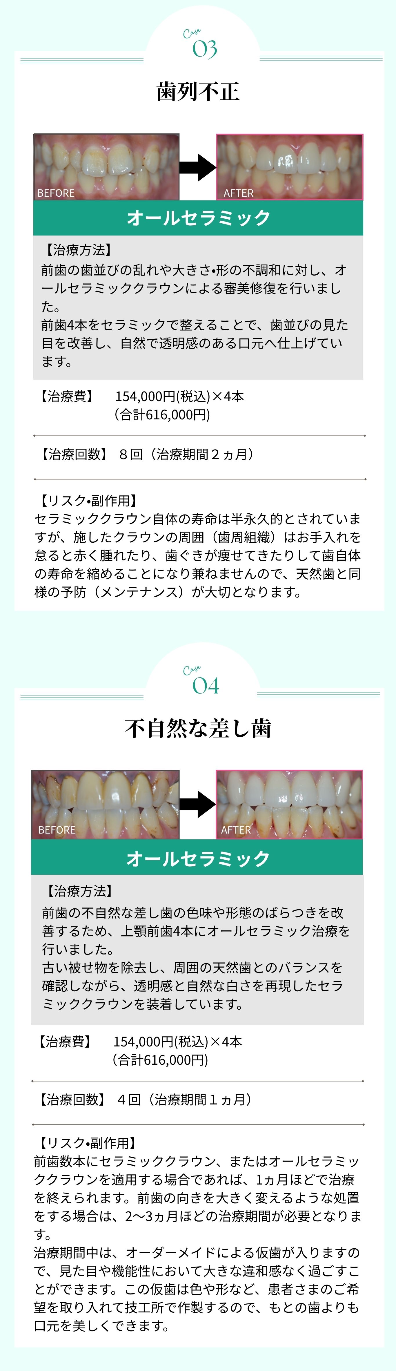 症例紹介 - 歯列不正、不自然な差し歯の治療例