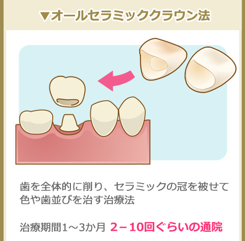オールセラミッククラウン法