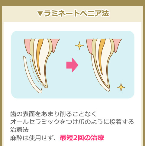 ラミネートべニア法