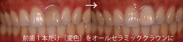 すきっ歯