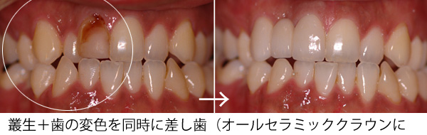 歯の変色・歯ぐきの黒ずみ