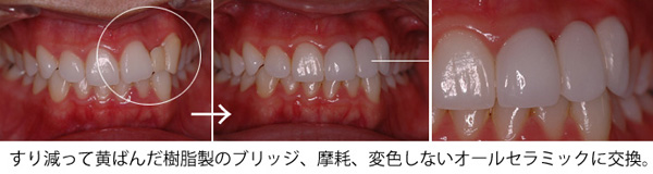 歯の変色・歯ぐきの黒ずみ