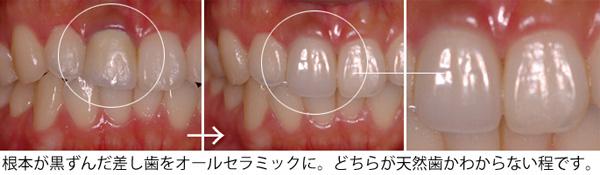 歯の変色・歯ぐきの黒ずみ