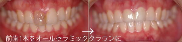 歯の変色・歯ぐきの黒ずみ