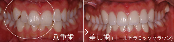 八重歯・乱杭歯・叢生