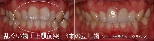 八重歯・乱杭歯・叢生