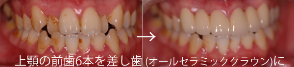 八重歯・乱杭歯・叢生