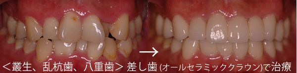 八重歯・乱杭歯・叢生