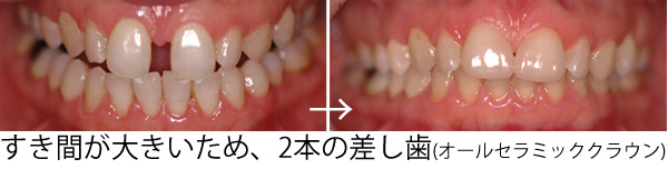 すきっ歯