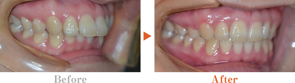 方 治し 自分 噛み 歯 合わせ で の
