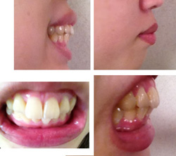 出っ歯 上顎前突 歯ぐき 症例写真 大阪の審美歯科 インプラント ウメダデンタルクリニック