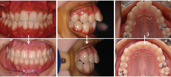 上顎前突、出っ歯