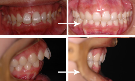出っ歯 上顎前突 歯ぐき 歯列矯正 大阪の矯正歯科ウメダデンタルクリニック