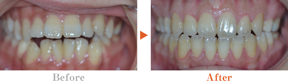 開咬 オープンバイト かいこう 歯列矯正 大阪の矯正歯科ウメダデンタルクリニック