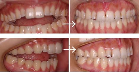 開咬 オープンバイト かいこう 歯列矯正 大阪の矯正歯科ウメダデンタルクリニック