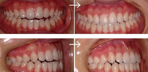 開咬 オープンバイト かいこう 歯列矯正 大阪の矯正歯科ウメダデンタルクリニック