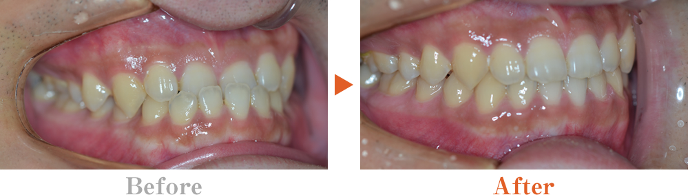 出っ歯（上顎前突）の特徴と原因、治療方法