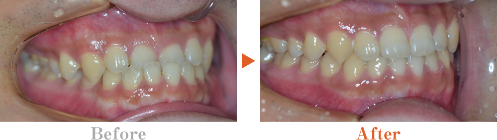 切端咬合 反対交合 受け口 しゃくれ 歯列矯正 大阪の矯正歯科ウメダデンタルクリニック
