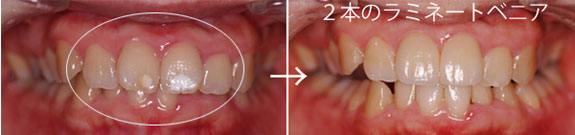 斑状歯