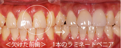 欠けた前歯・不自然な差し歯