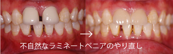 欠けた前歯・不自然な差し歯