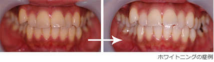 ホワイトニング・クリーニングで歯の色を白くする