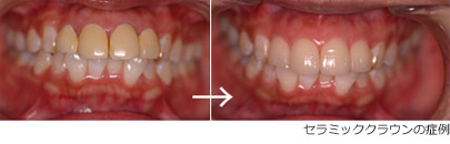 ラミネートベニア、セラミッククラウンで歯の色を白くする
