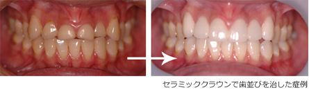 ラミネートベニア、セラミッククラウンで歯並びを治す