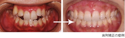 歯列矯正で歯並びを治す