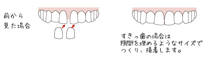 ラミネートベニア法02