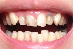 症例紹介 歯の変色 テトラサイクリン ホワイトスポット 斑状歯を治す ウメダデンタルクリニック 大阪の審美 矯正 インプラント