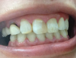症例紹介 歯の変色 テトラサイクリン ホワイトスポット 斑状歯を治す ウメダデンタルクリニック 大阪の審美 矯正 インプラント