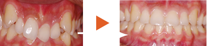 八重歯･叢生･乱杭歯の歯列矯正での治療例