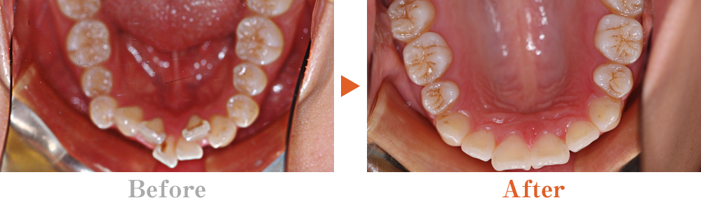 八重歯･叢生(そうせい)･乱杭歯の特徴と原因、治療方法